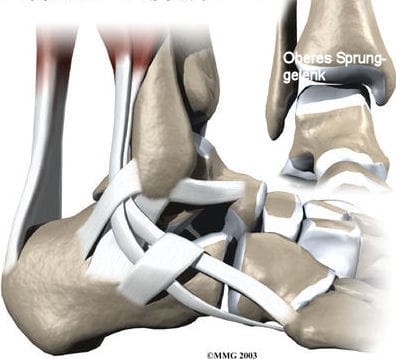 Arthrose des Sprunggelenkes (OSG Arthrose)